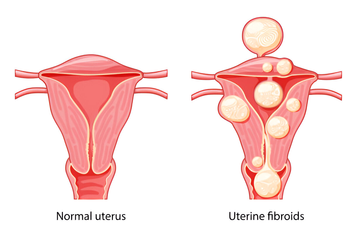 can a fibroid cause constipation