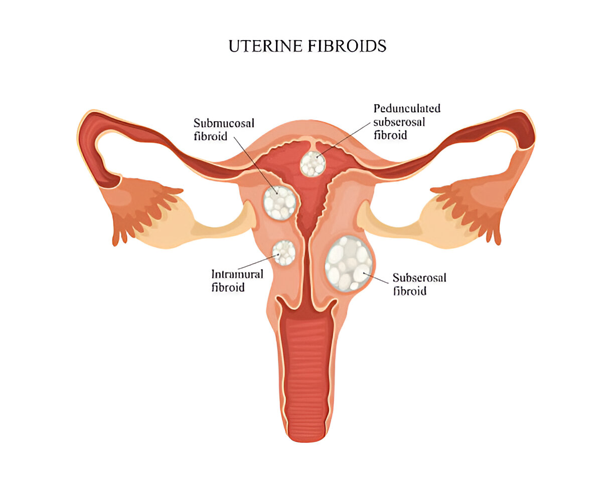 What size of Fibroid is dangerous?