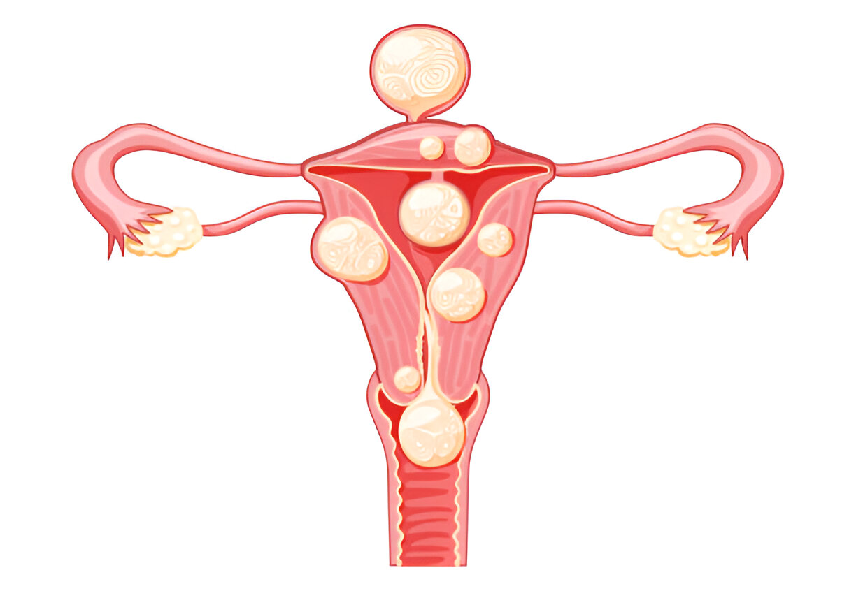Can Uterine fibroids cause weight gain?